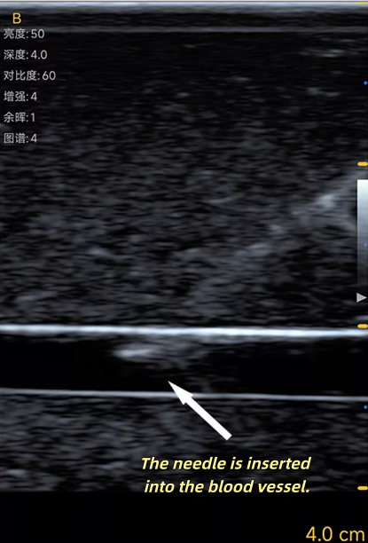 Ultrasound Vascular Puncture T - Medical Gel Ultrasound recension och pris